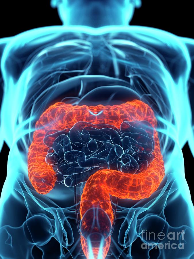 Diseased Colon Photograph By Sebastian Kaulitzkiscience Photo Library Fine Art America 1129