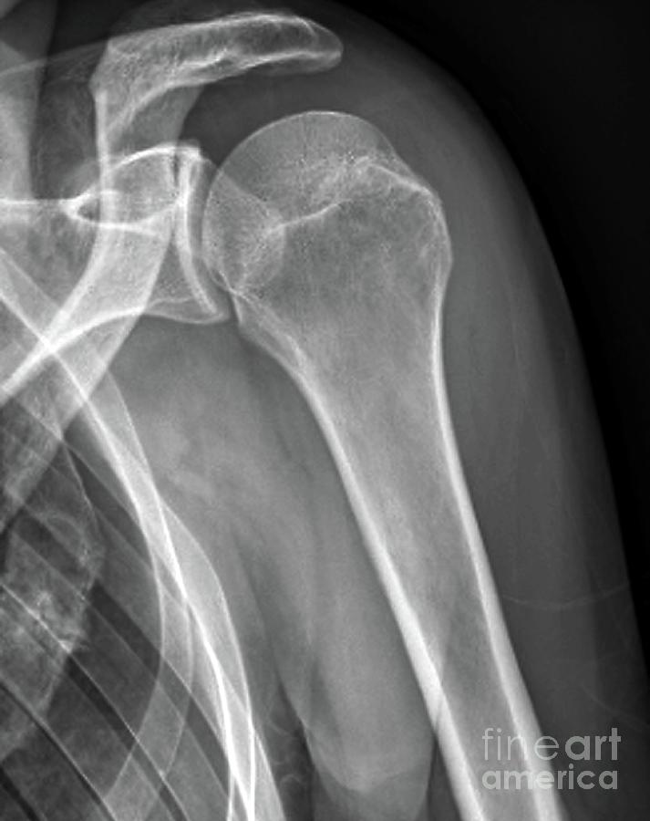 Dislocated Shoulder Photograph By Zephyrscience Photo Library Fine Art America 7455