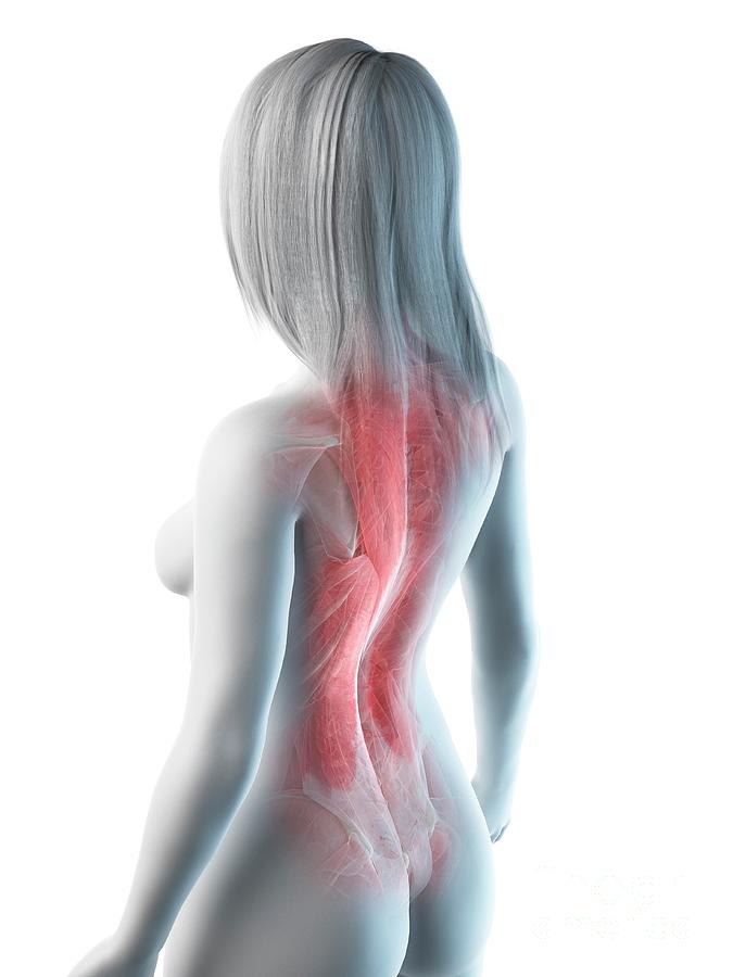 Female back muscles, illustration - Stock Image - C052/4269 - Science Photo  Library