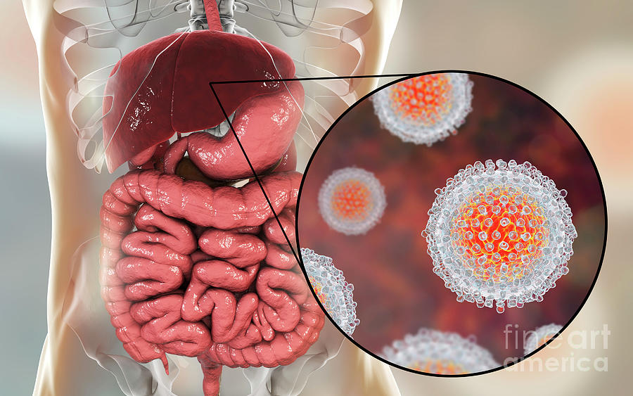 Hepatitis C Infection #5 by Kateryna Kon/science Photo Library