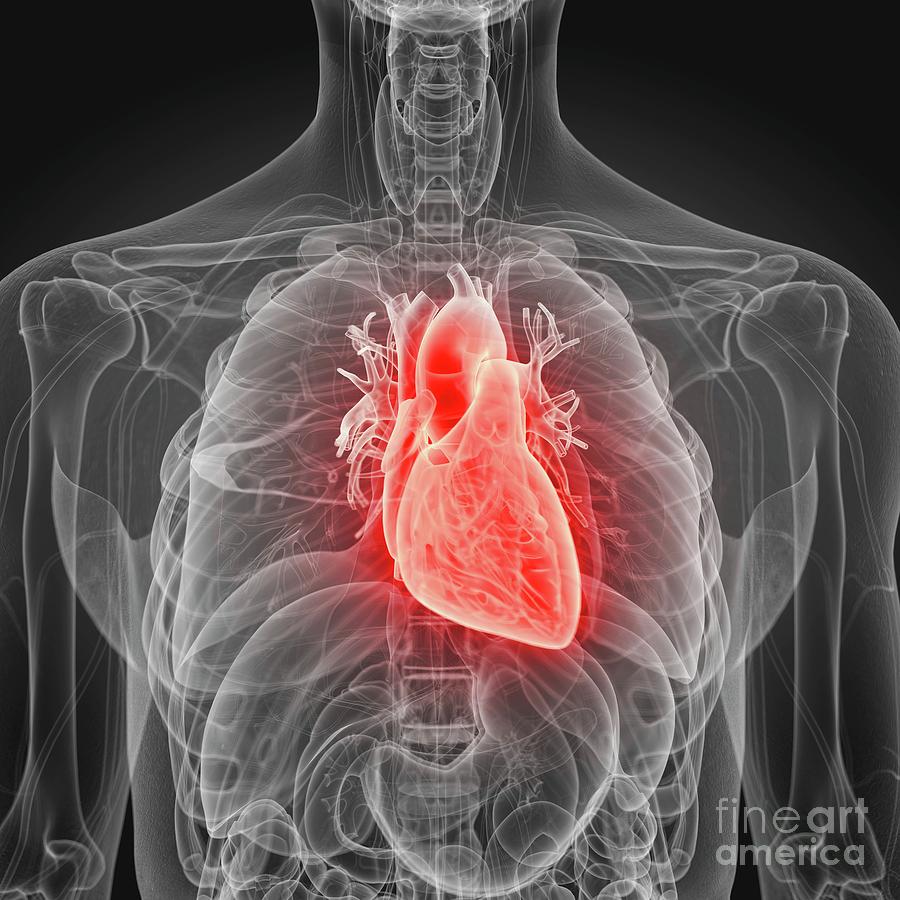 3d Photograph - Illustration Of An Inflamed Heart #5 by Sebastian Kaulitzki/science Photo Library