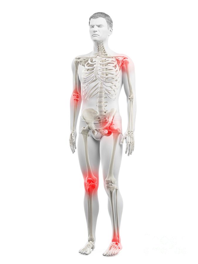 Joint Pain #5 Photograph by Science Photo Library Joint Pain #5 Photograph by Science Photo Library
