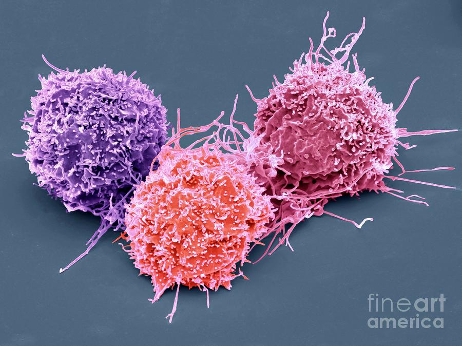 Lung Cancer Cells #5 Photograph by Steve Gschmeissner/science Photo Library