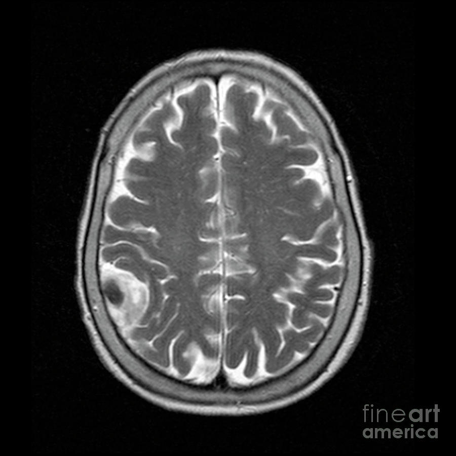 Meningioma Tumour Photograph by Simon Fraser/science Photo Library ...