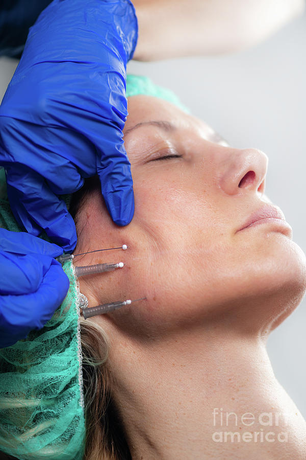 Mesotherapy Thread Face Lift Procedure #5 Photograph by Microgen Images/science Photo Library
