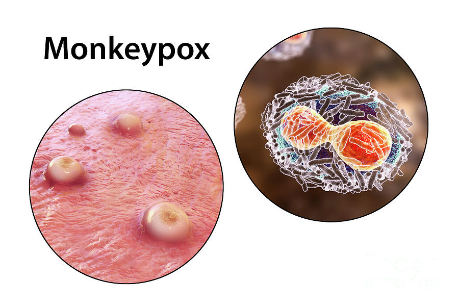 Monkeypox Infection And Virus Photograph By Kateryna Kon Science Photo Library Fine Art America