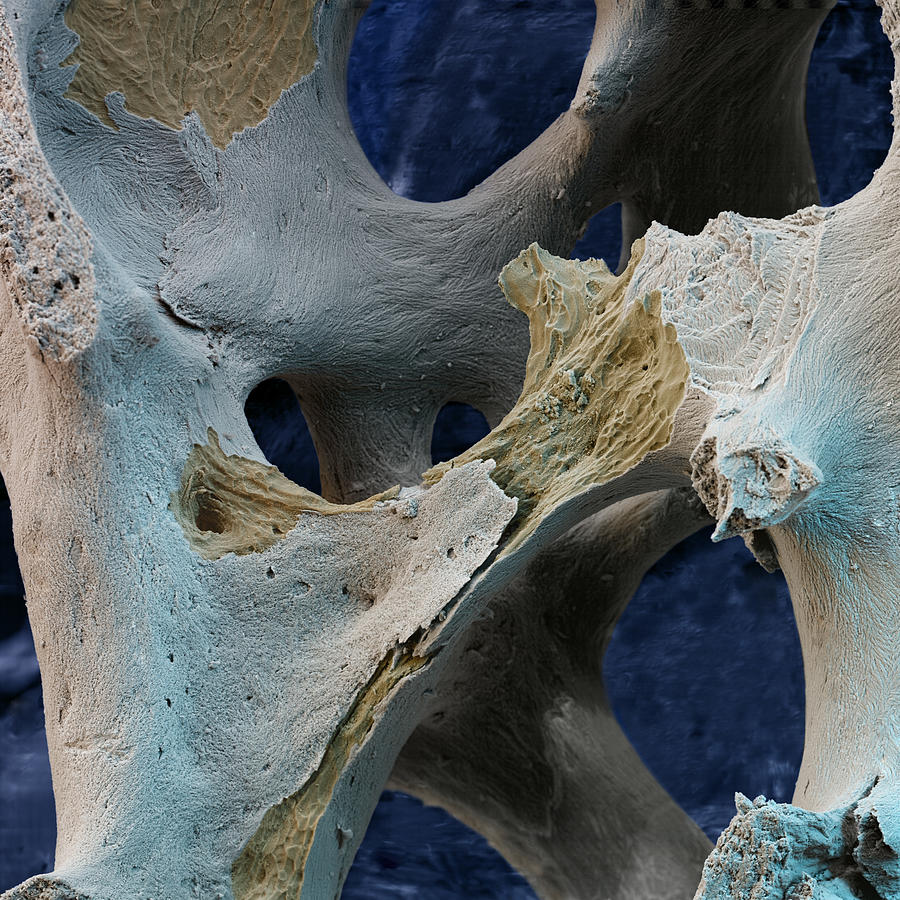 Osteoporotic Bone #5 Photograph by Meckes/ottawa