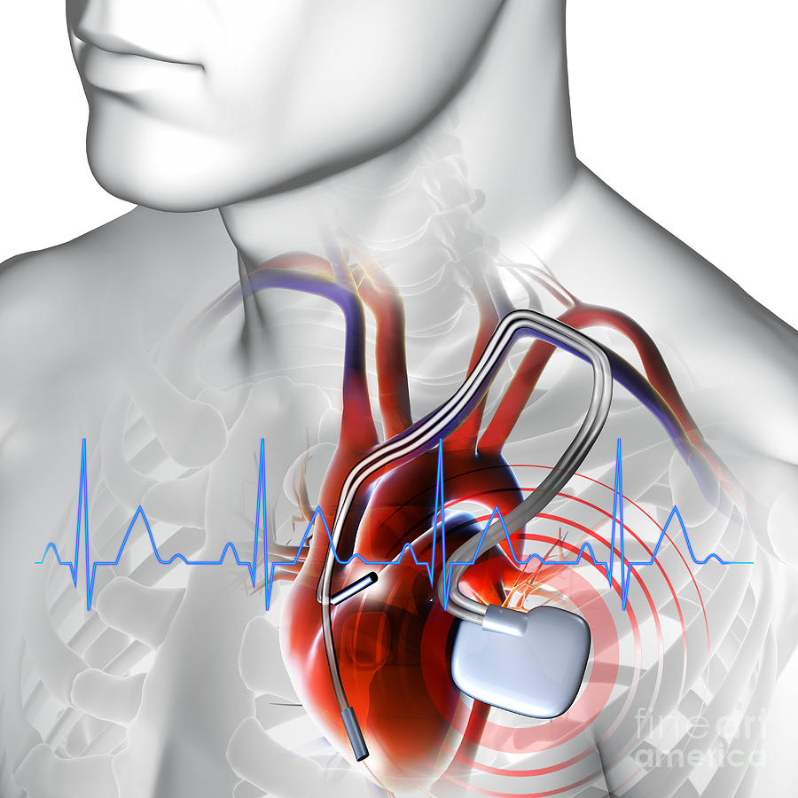 Pacemaker Photograph by Fernando Da Cunha/science Photo Library | Pixels