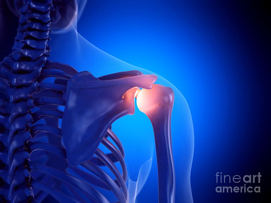 Painful Shoulder Joint #5 Photograph by Sebastian Kaulitzki/science Photo Library