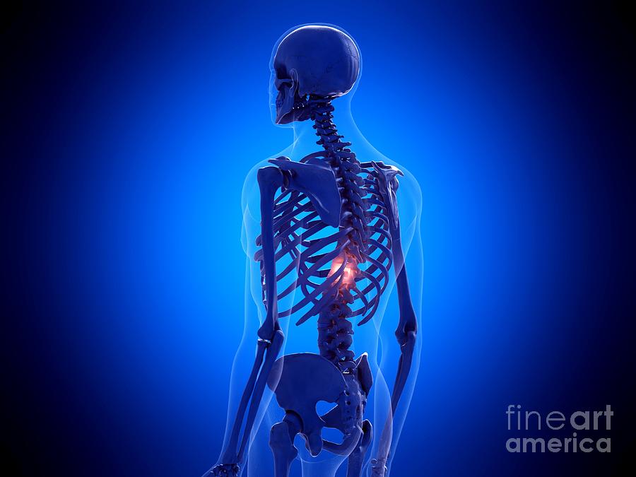 Painful Spine #5 Photograph by Sebastian Kaulitzki/science Photo Library