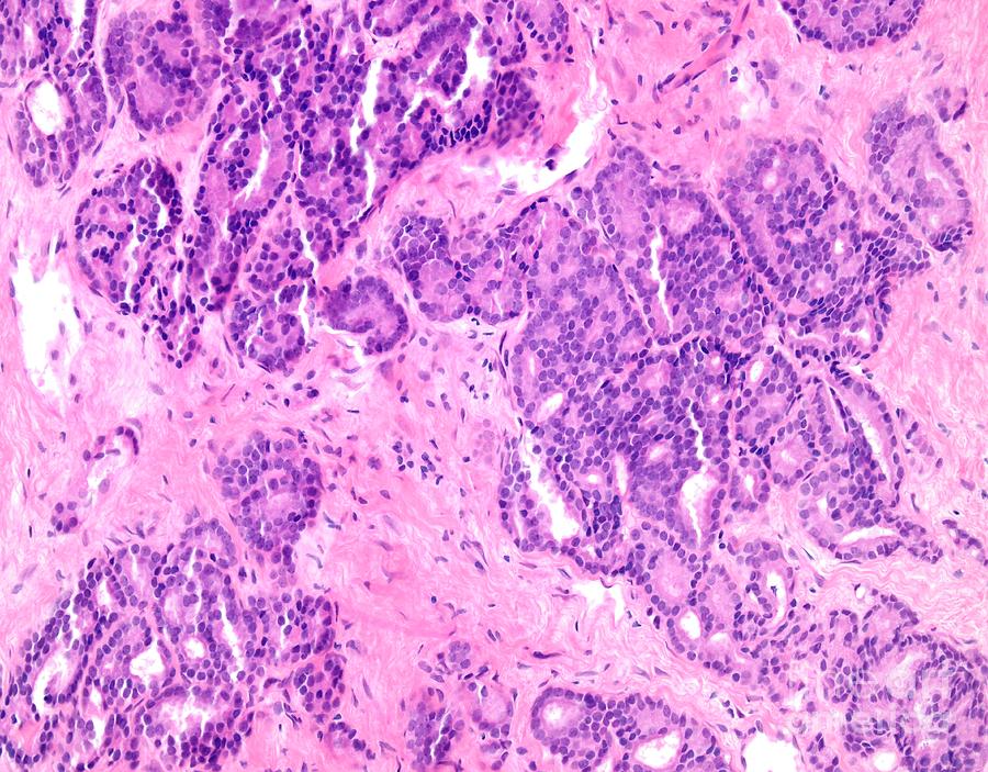 Prostate Cancer Photograph by Webpathology/science Photo Library