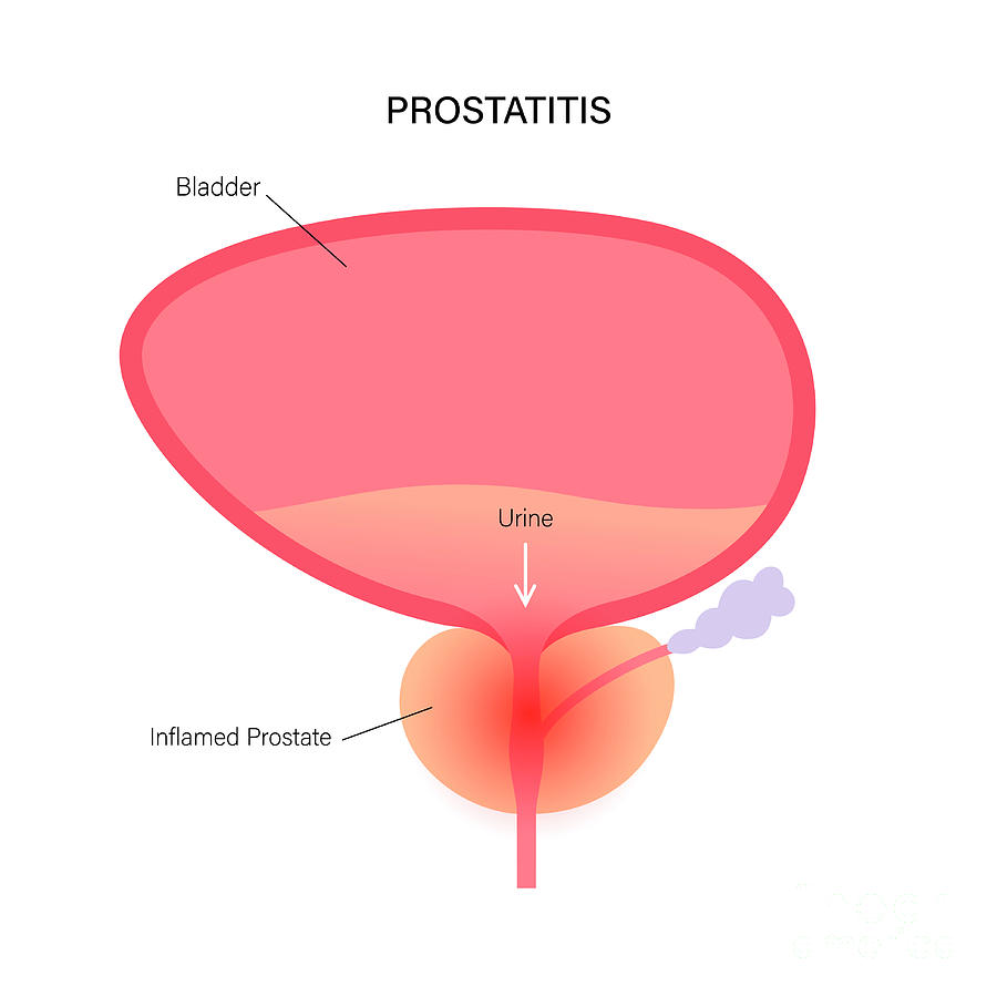 Prostatitis #5 Photograph by Pikovit / Science Photo Library