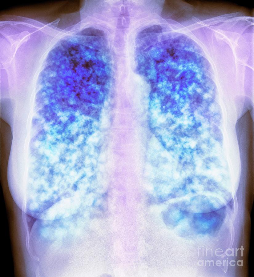 Secondary Lung Cancer Photograph by Science Photo Library