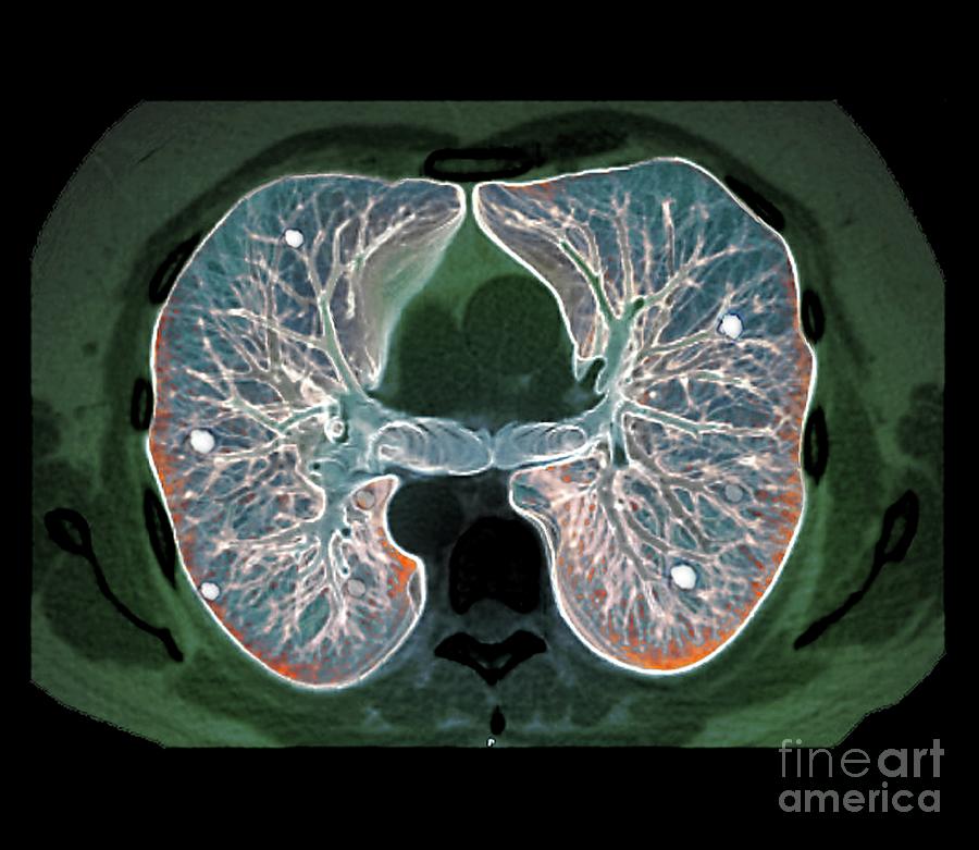 Secondary Lung Cancer Photograph by Zephyr/science Photo Library - Pixels