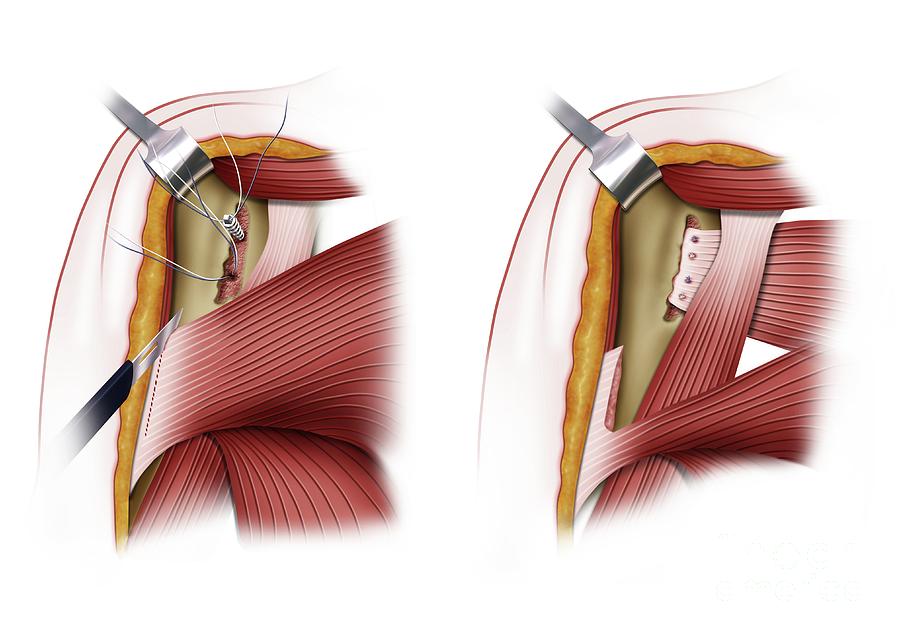 Shoulder Muscles Surgery Photograph by Maurizio De Angelis/science ...