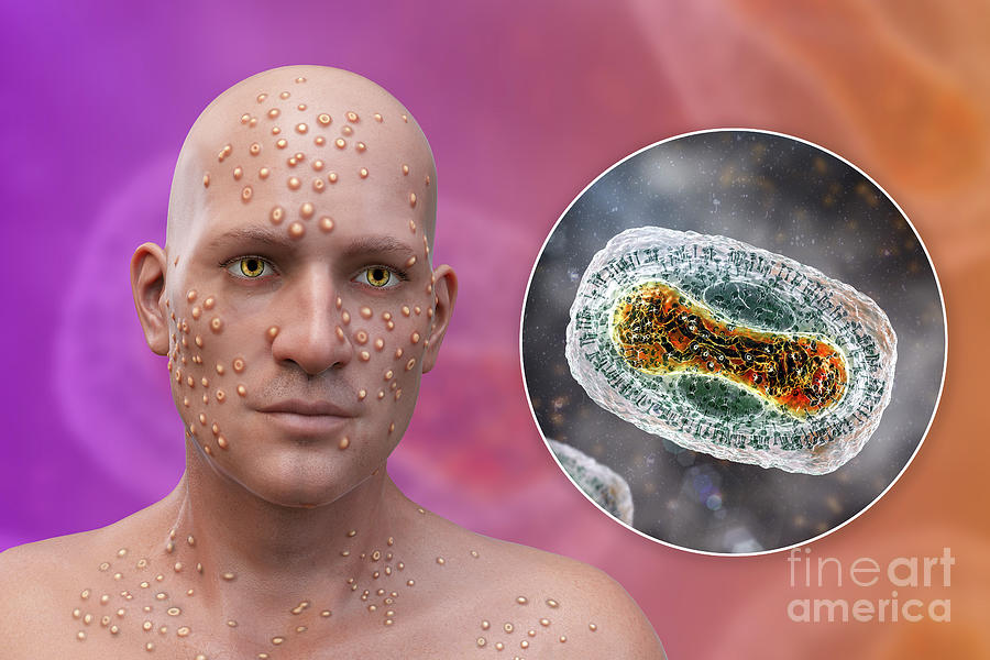 Smallpox Virus Infection #5 by Kateryna Kon/science Photo Library