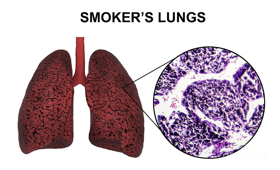 Smokers Lungs Photograph By Kateryna Konscience Photo Library Fine Art America 8596