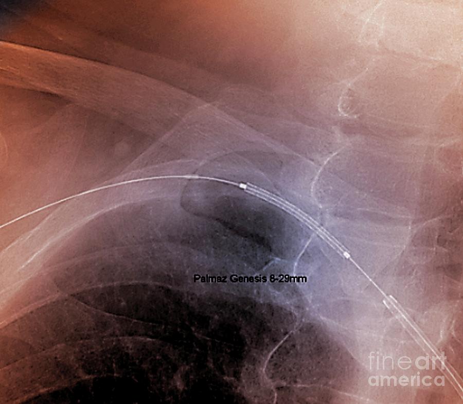 Treatment Of Reduced Blood Flow #5 Photograph by Zephyr/science Photo Library