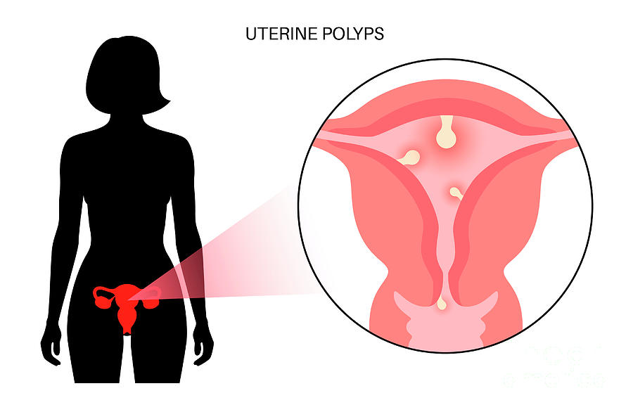 uterine polyps