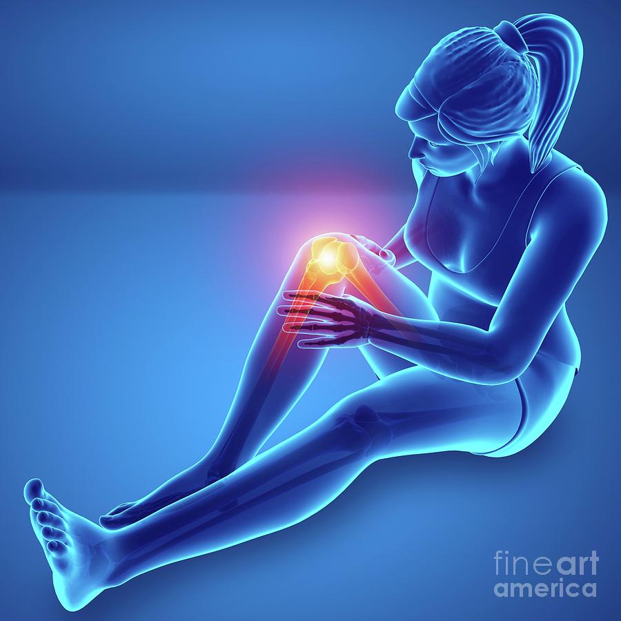 Skeleton Photograph - Woman With Knee Pain #53 by Pixologicstudio/science Photo Library