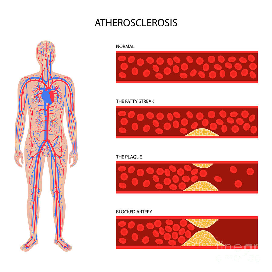 Atherosclerosis Photograph by Pikovit / Science Photo Library - Fine ...