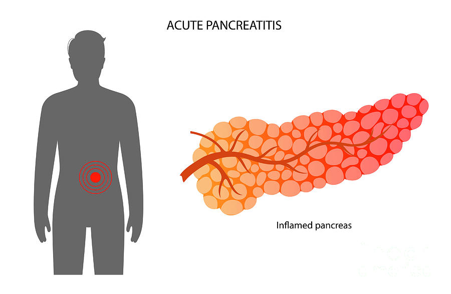Acute Pancreatitis #6 Photograph by Pikovit / Science Photo Library