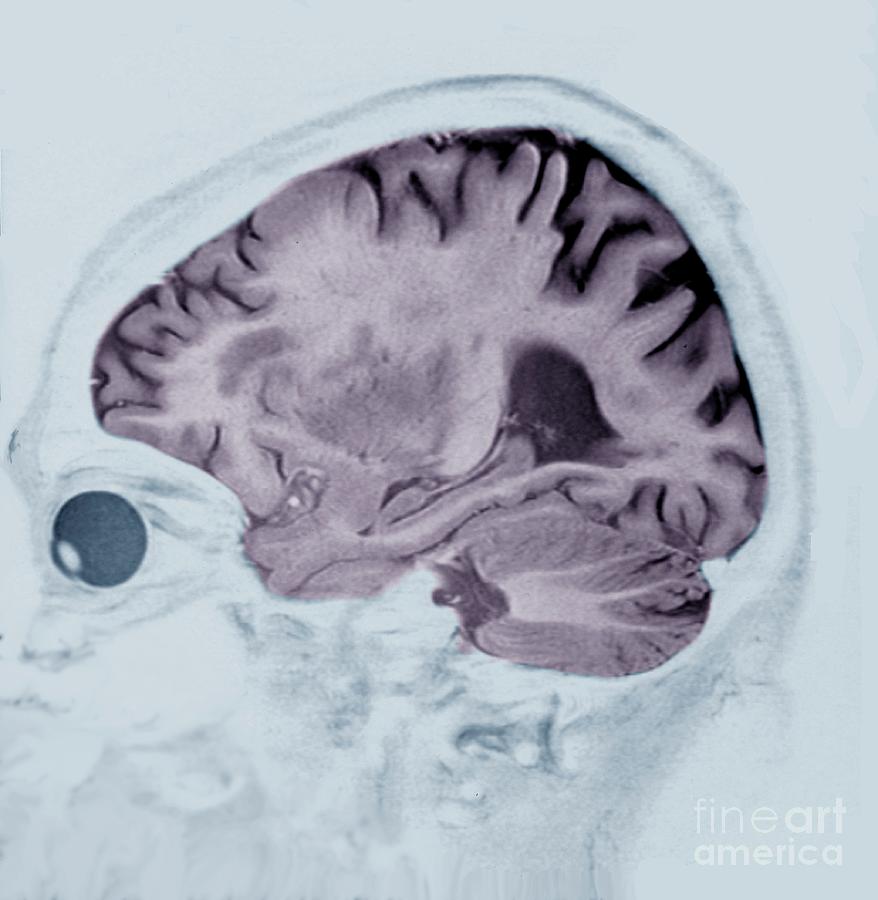 Alzheimers Disease #6 Photograph by Zephyr/science Photo Library