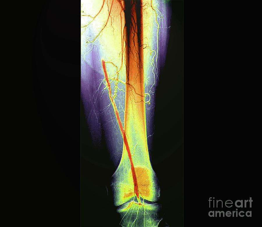 Blocked Femoral Artery Photograph By Zephyrscience Photo Library Fine Art America 5703