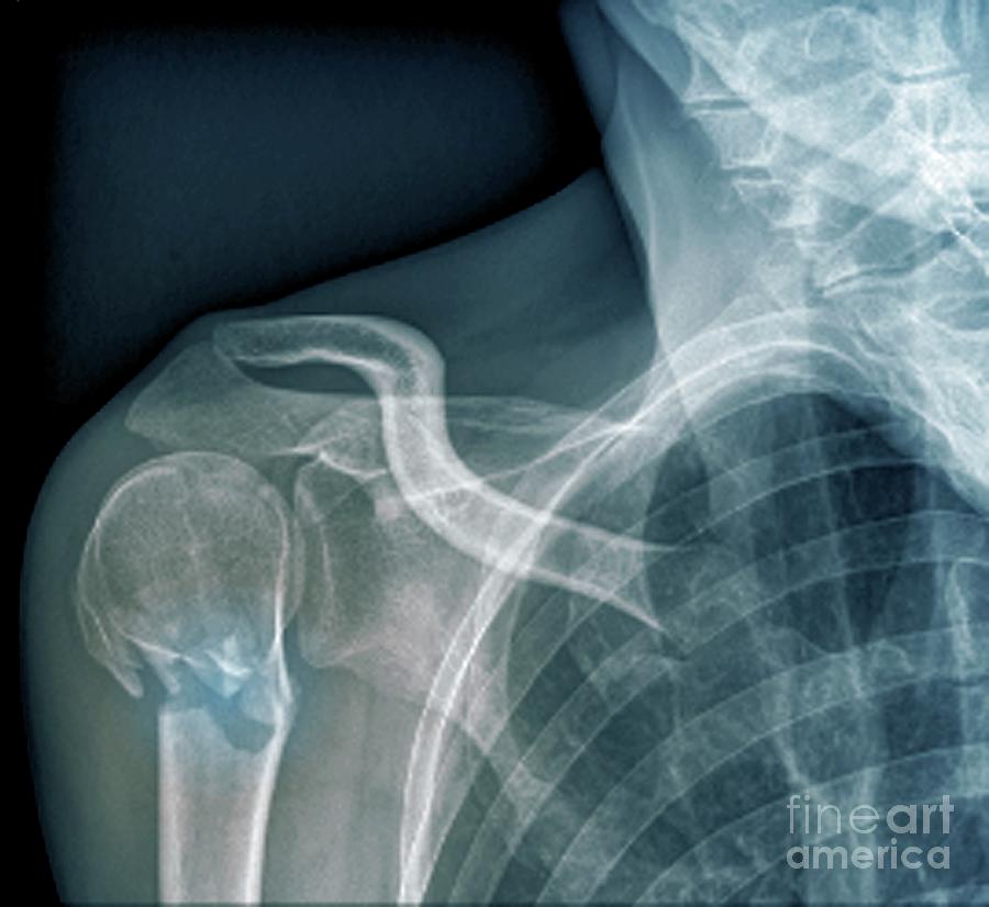 Broken Upper Arm Bone #6 Photograph by Zephyr/science Photo Library
