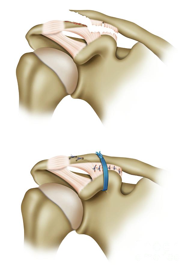 Clavicle Fracture Repair Surgery #6 Photograph by Maurizio De Angelis ...