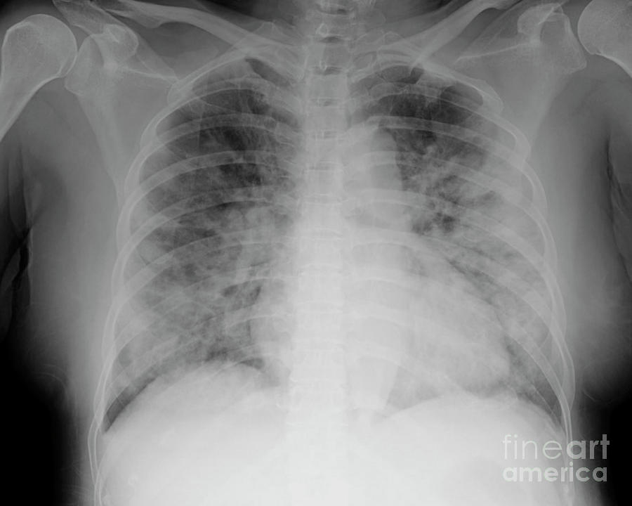 Covid-19 Pneumonia Photograph By Rajaaisya Science Photo Library - Fine 