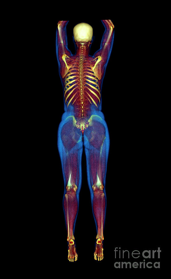 Female Body Photograph by Antoine Rosset/science Photo Library