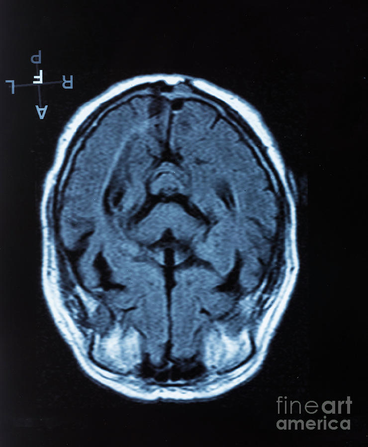 Human Brain #6 Photograph by Wladimir Bulgar/science Photo Library