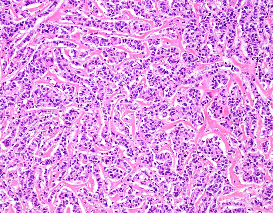 Invasive Lobular Breast Cancer Photograph By Webpathology Science Photo Library