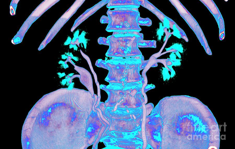 Kidneys And Duplicated Ureter #6 Photograph by Vsevolod Zviryk/science Photo Library