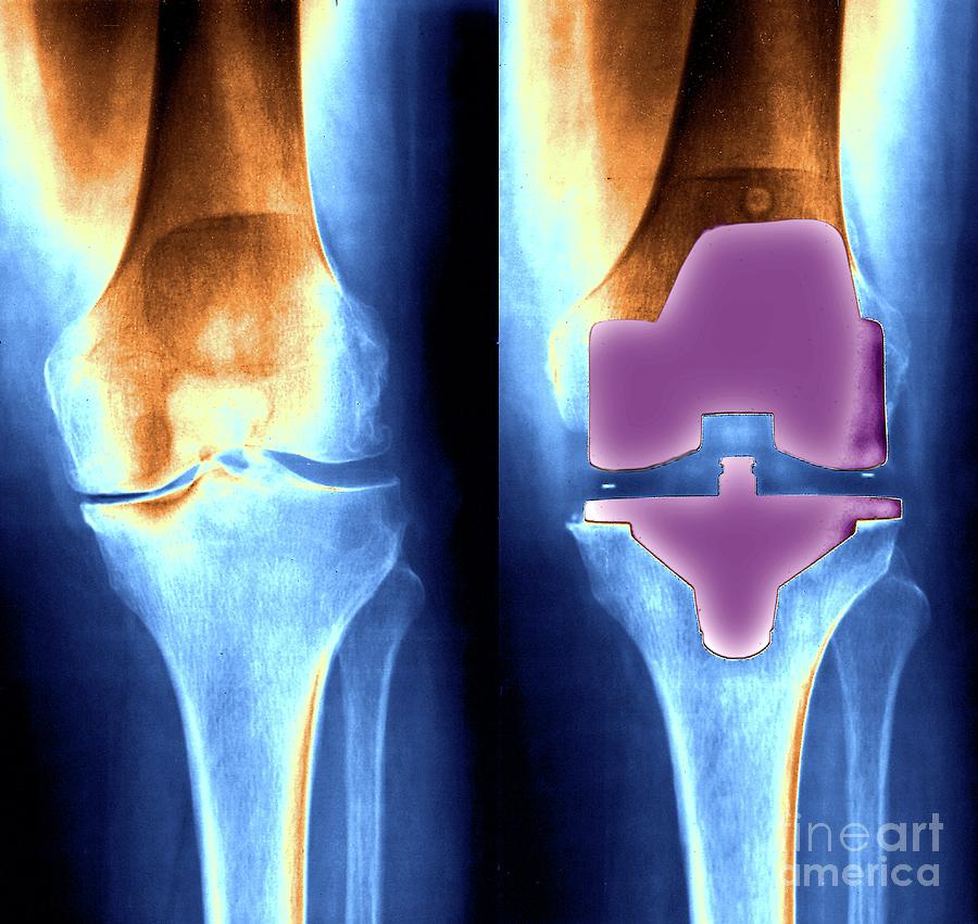 Knee Replacement Photograph By Zephyr Science Photo Library Fine Art America