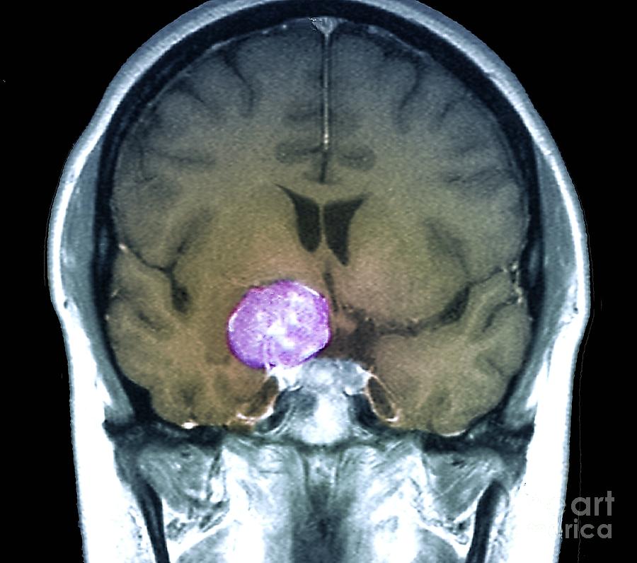 Meningioma Brain Tumour Photograph by Zephyr/science Photo Library