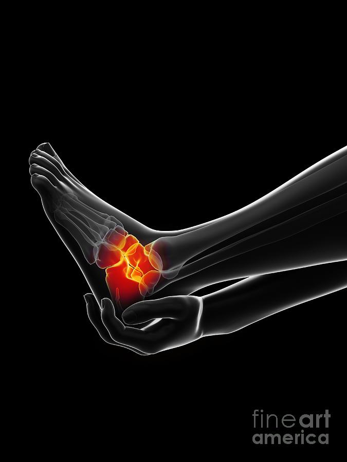 Painful Ankle #6 Photograph by Sebastian Kaulitzki/science Photo Library