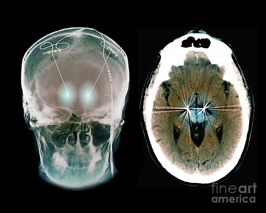 Skull Photograph - Parkinsons Disease Brain Stimulation Electrodes #6 by Zephyr/science Photo Library