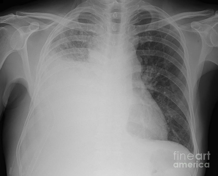 Pleural Effusion Photograph By Rajaaisya Science Photo Library - Fine 