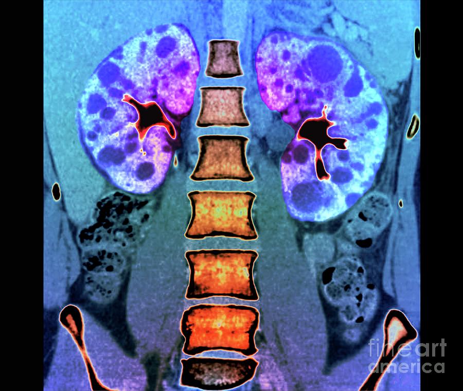 Polycystic Kidneys Photograph by Zephyr/science Photo Library - Fine ...