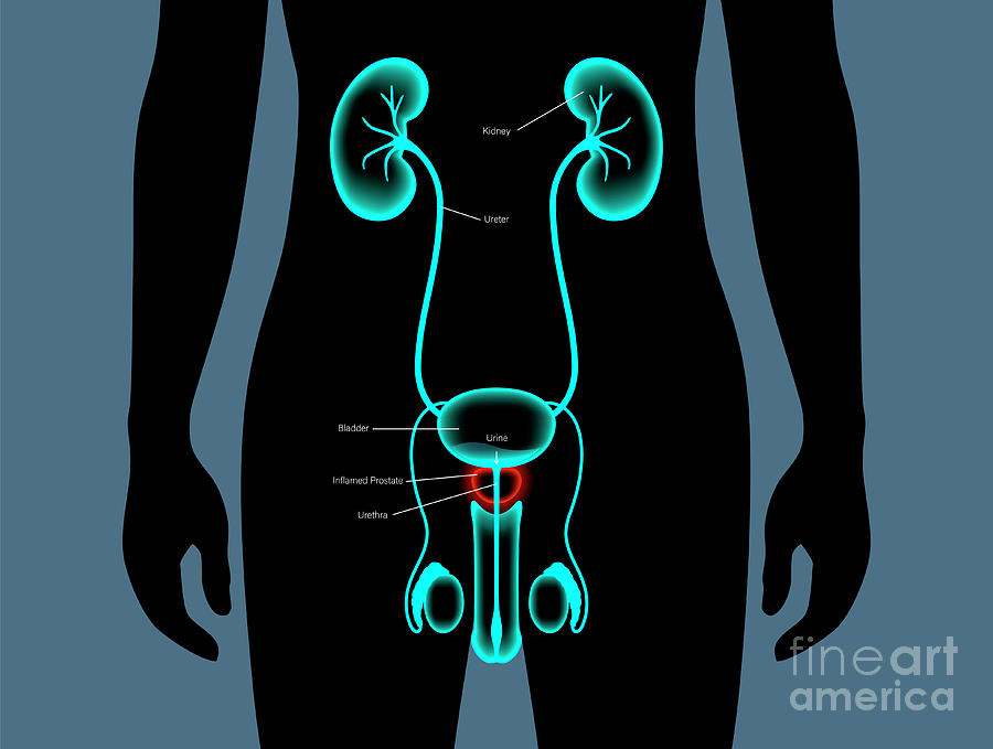 Prostatitis #6 Photograph by Pikovit / Science Photo Library - Pixels