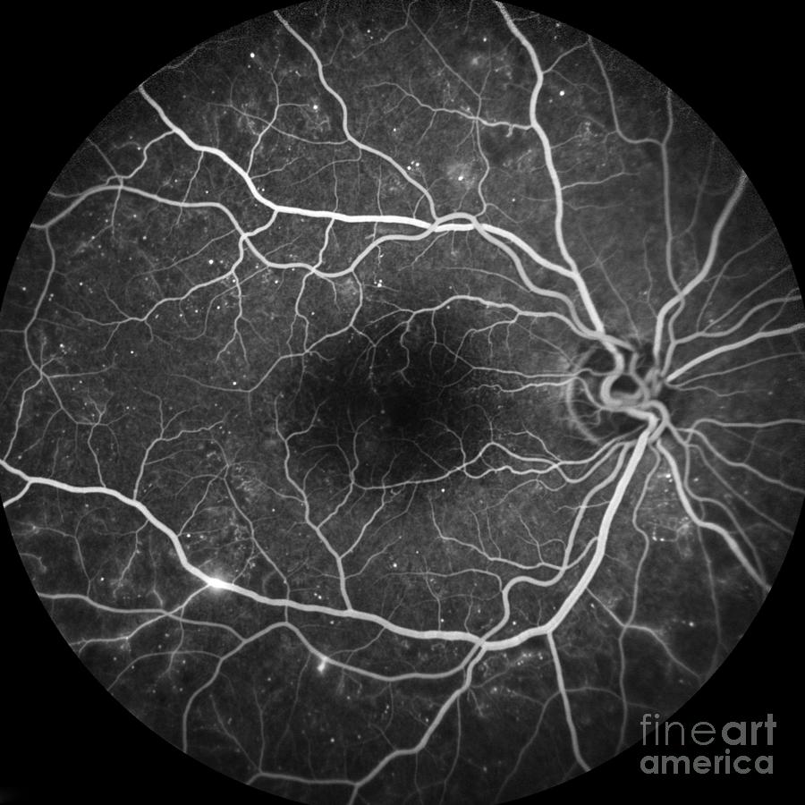 Retina Damage From Diabetes #6 Photograph by Alan Frohlichstein/science Photo Library