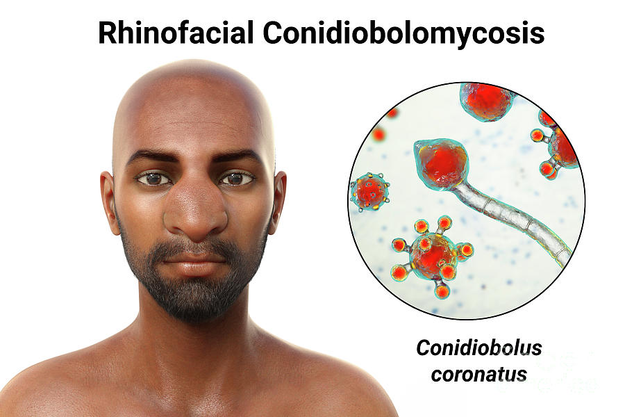 Rhinofacial Conidiobolomycosis And Fungus #6 by Kateryna Kon/science ...