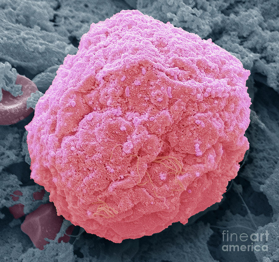 Sarcoma #6 Photograph by Steve Gschmeissner/science Photo Library