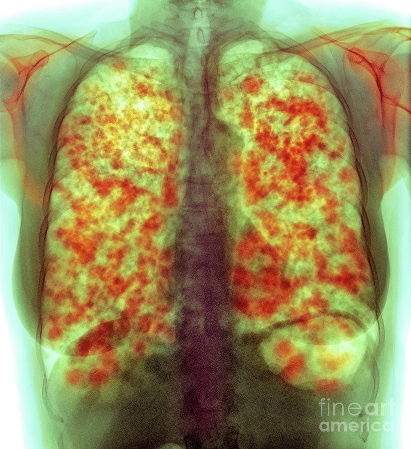 Secondary Lung Cancer Photograph by Science Photo Library