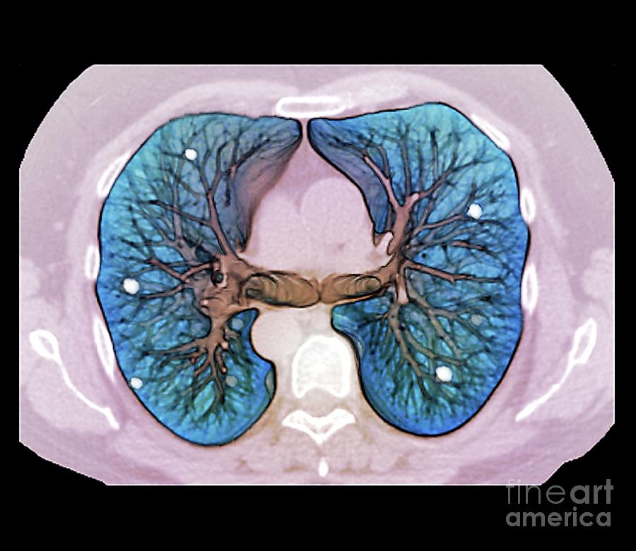 Secondary Lung Cancer Photograph by Zephyr/science Photo Library - Fine ...