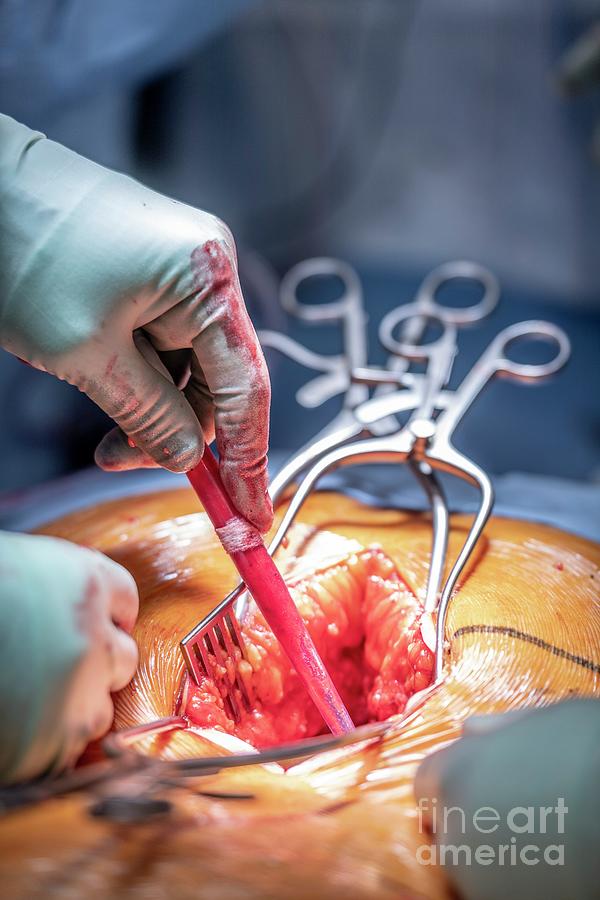 Spinal Surgery #6 Photograph by Jim Varney/science Photo Library