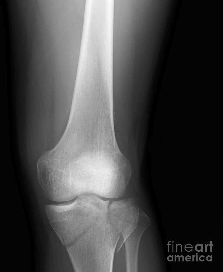 Tibial Plateau Fracture 6 By Science Photo Library