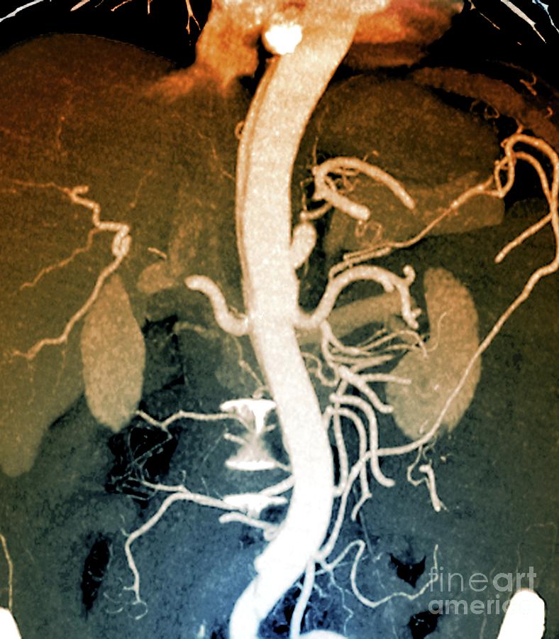 Abdominal Aortic Aneurysm Photograph By Zephyr/science Photo Library ...